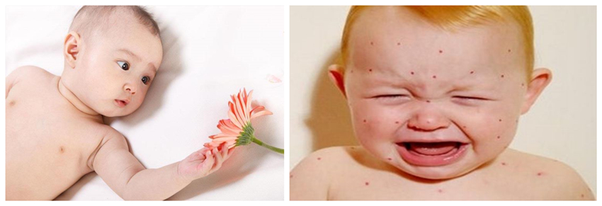 兒童濕疹反反復(fù)復(fù)，您有在家安裝家用除濕產(chǎn)品嗎？